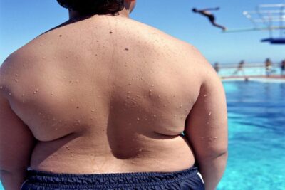 الكرش ، انتفاخ البطن ، السمنة ، حرق الدهون