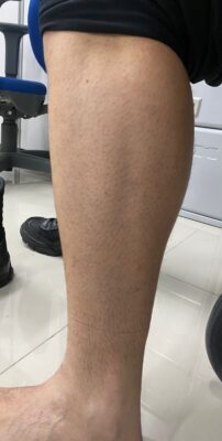 أختفاء شعر القدمين، ألم الساق قبل النوم