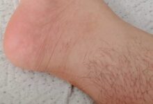 أختفاء شعر القدمين