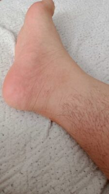 أختفاء شعر القدمين