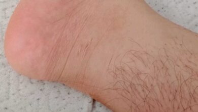 أختفاء شعر القدمين