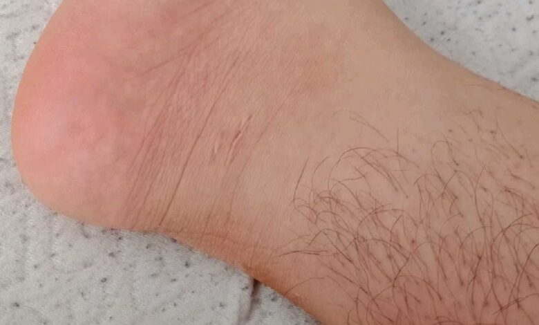 أختفاء شعر القدمين
